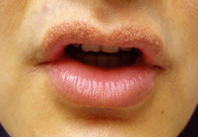 How To Get Rid Of Fordyce Spots On Lips Yabibo