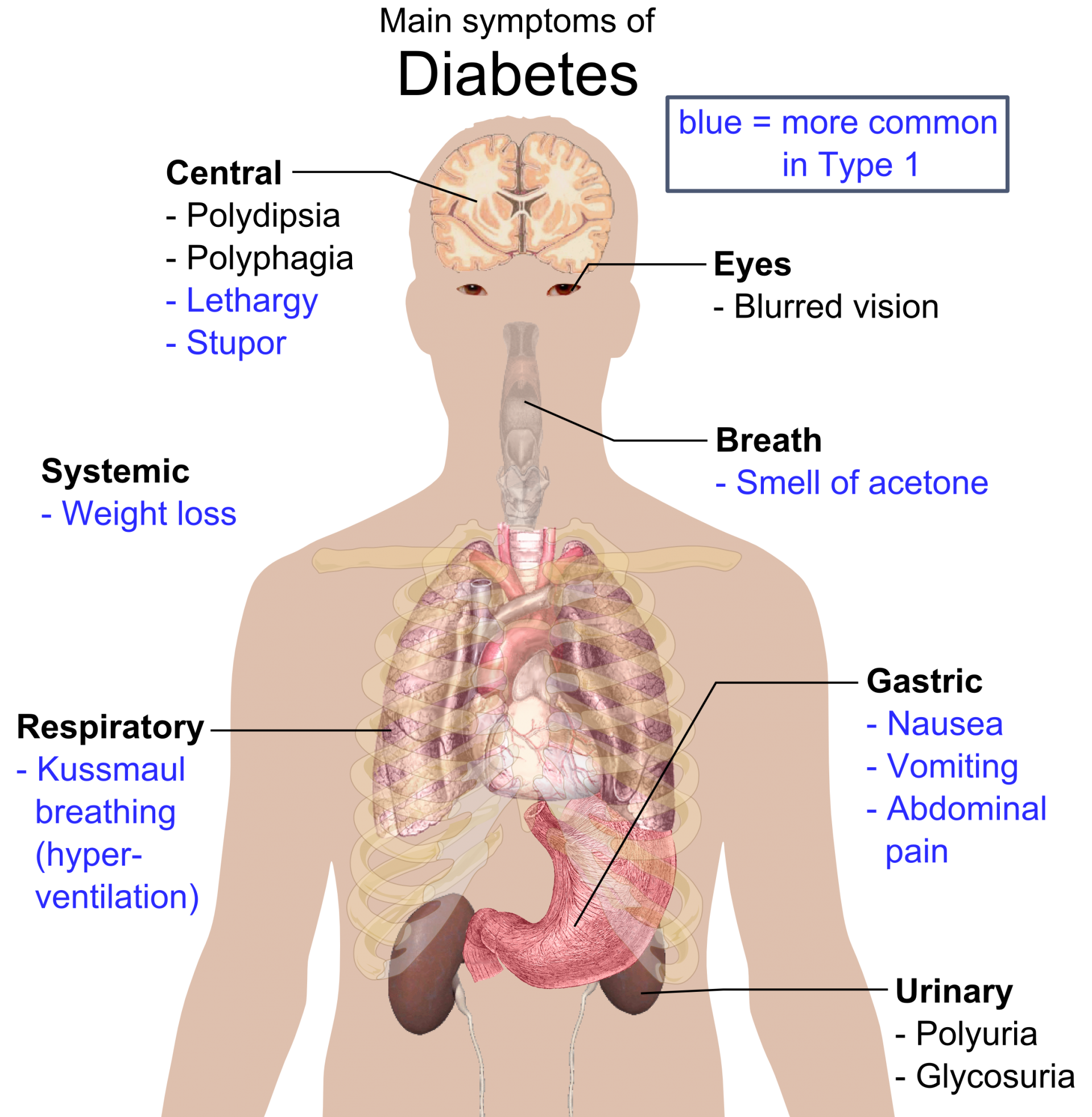 diabetes-mellitus-type-1-also-known-as-juvenile-diabetes