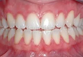 Gingivitis- a common dental disease