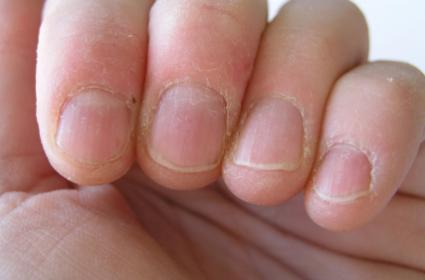 nails picking cuticles skin nail disease bed cuticle compulsive around peeling beds health treat systemic fingernail fingernails heart problems naturally