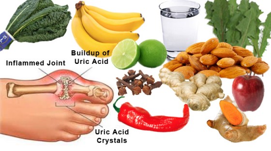 Diet Chart For High Uric Acid Condition Symptoms And Treatments   Gout Treatment 560x312 