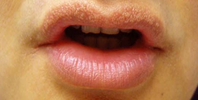 how-to-get-rid-of-fordyce-spots-on-lips-yabibo