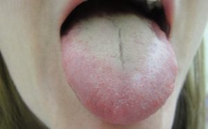 How to Get Rid of White Tongue - Yabibo