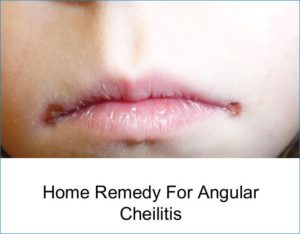 Best Natural Home Remedies For Angular Cheilitis - Yabibo