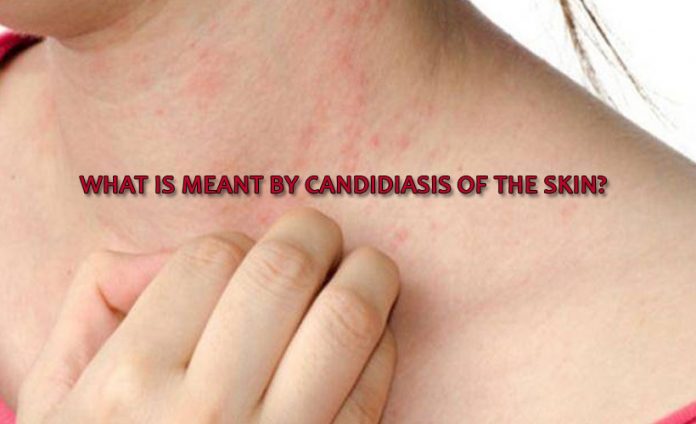 What is meant by candidiasis of the skin? - Yabibo
