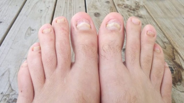 Top 10 Essential Oils for Toenail Fungus