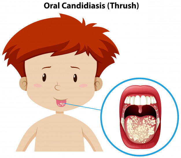 9 Candida Symptoms And 3 Steps To Treat Them Yabibo