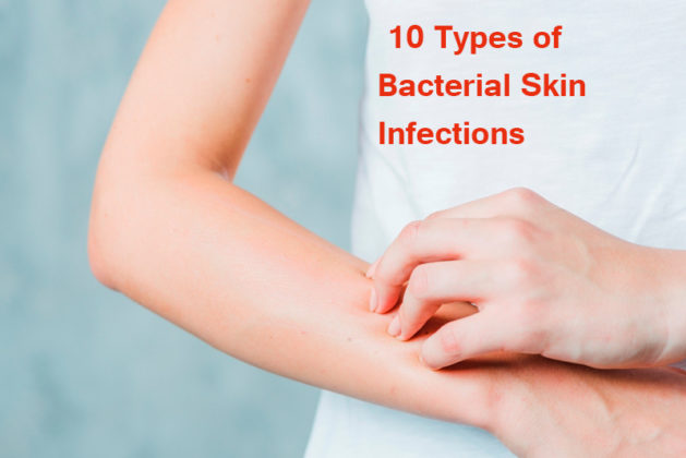 10 Types Of Bacterial Skin Infections - Yabibo